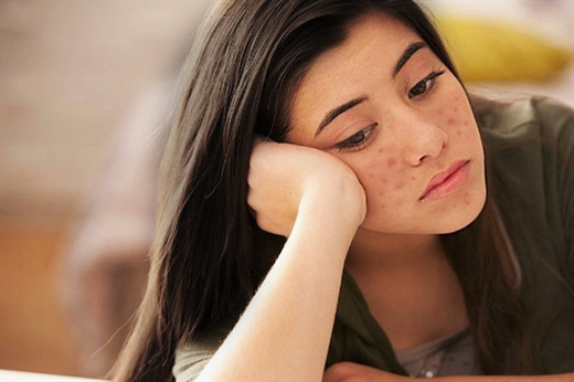 Xuẩt hiện nhiều mụn chứng tỏ cơ thể bạn đang có vấn đề