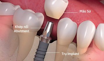 Nha khoa trồng răng với liệu pháp không đau dành cho người trung niên