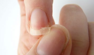 Móng tay bất thường báo hiệu sức khỏe của bạn đang gặp vấn đề