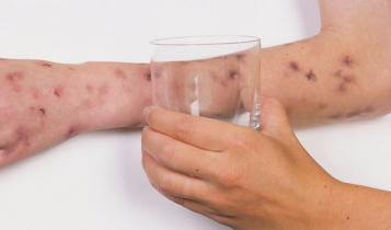 Cách phân biệt phát ban và viêm màng não