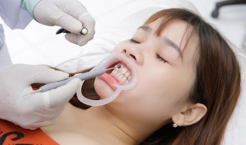 Chỉnh răng cho trẻ khi nào?