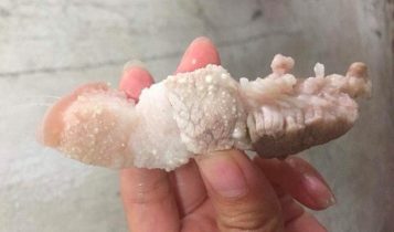 Nhiễm sán lợn nguy hiểm như thế nào?