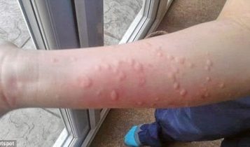 Mề đay cấp và thuốc chữa