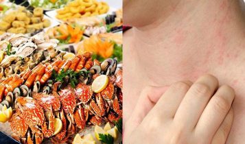 Cách phòng và chữa trị dị ứng hải sản