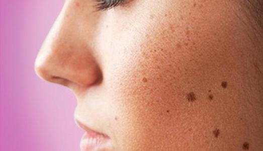 Cách hạn chế đồi mồi trên da