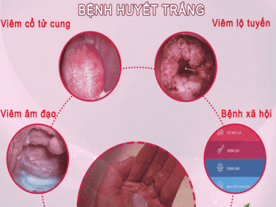 Huyết trắng, khi nào là bệnh lý?