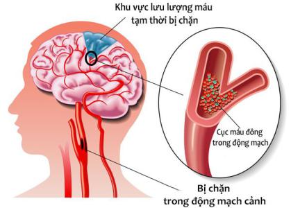 ‘Cảnh giác’ với căn bệnh thiếu máu não