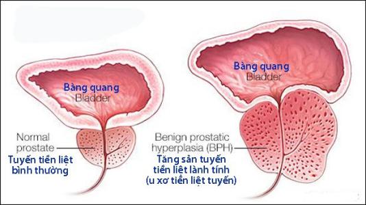 Các bệnh thường gặp ở tuyến tiền liệt