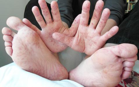 6 lưu ý của Bộ Y tế để phòng tránh và nhận biết bệnh chân tay miệng kịp thời