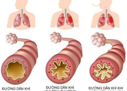 Cách kiểm soát bệnh hen suyễn hiệu quả