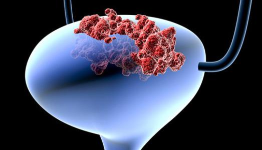 Nam giới đau tức bìu, cảnh giác với ung thư tinh hoàn