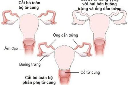 Khắc phục tình trạng sức khoẻ sau khi cắt bỏ tử cung thế nào?