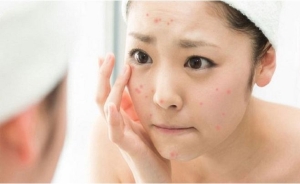 Chăm sóc da sau nặn mụn để chống tình trạng sẹo thâm