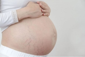 Cách làm mờ vết rạn da khi mang bầu an toàn hiệu quả