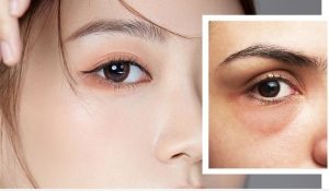 5 cách phục tình trạng bọng mắt