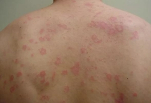 Bệnh giang mai: 5 câu hỏi thường gặp nhất