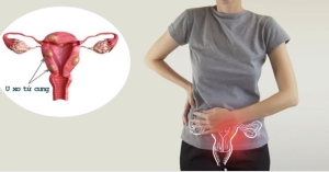 Bệnh u xơ tử cung có gây hiếm muộn không