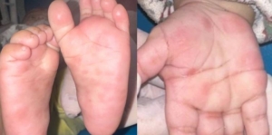 Giang mai bẩm sinh bác sĩ chỉ cách phát hiện sớm và điều trị