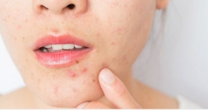 Mụn kéo dài dai dẳng, 6 sai lầm và cách xử lý đúng để da phục hồi hiệu quả