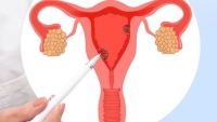 Hội chứng buồng trứng đa nang hay còn gọi là 