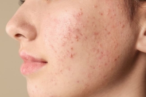 Hỗ trợ da thông thoáng và mịn màng hơn cùng 5 cách giúp giảm mụn cám tại nhà