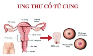Sàng lọc ung thư cổ tử cung dễ dàng hơn