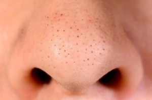 6 sai lầm chăm sóc da khiến mụn đầu đen