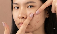 6 cách hạn chế mụn trứng cá trong kỳ kinh nguyệt