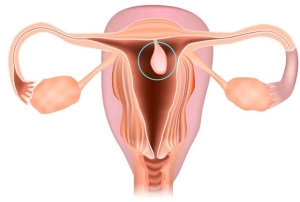 Polyp nội mạc tử cung: Đa số lành tính nhưng không nên chủ quan