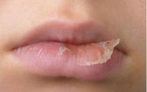 Môi khô, bong tróc khi giao mùa: 4 cách chăm sóc và những điều cần tránh